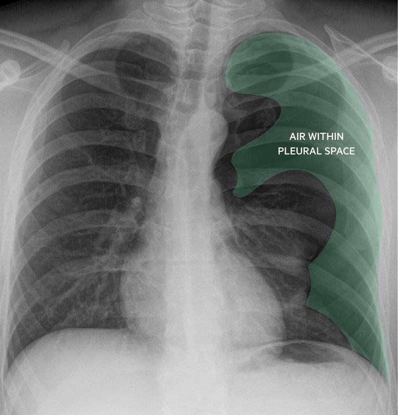 Pulsenotes Spontaneous Pneumothorax Notes