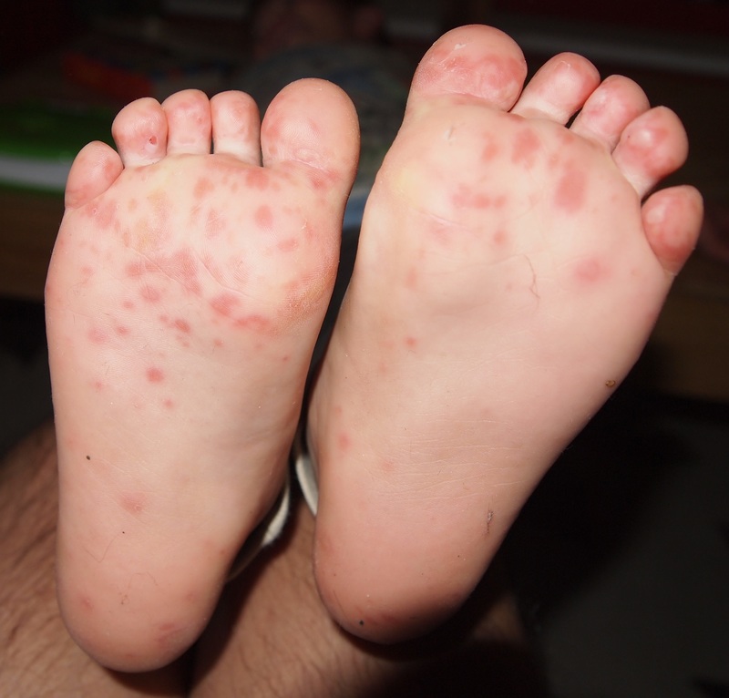 Hand, foot and mouth disease in a child