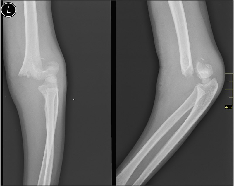 Supracondylar fracture