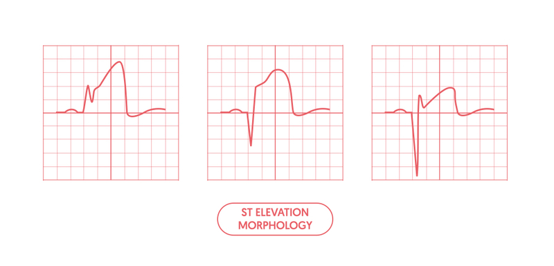 ECG showing 0.5-1 mm ST segment elevation in lead III, TWI in leads III