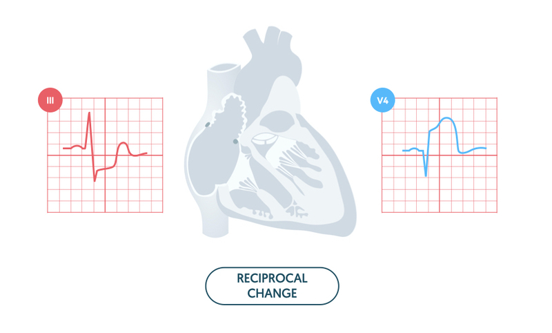 Pulsenotes  ST segment and T waves