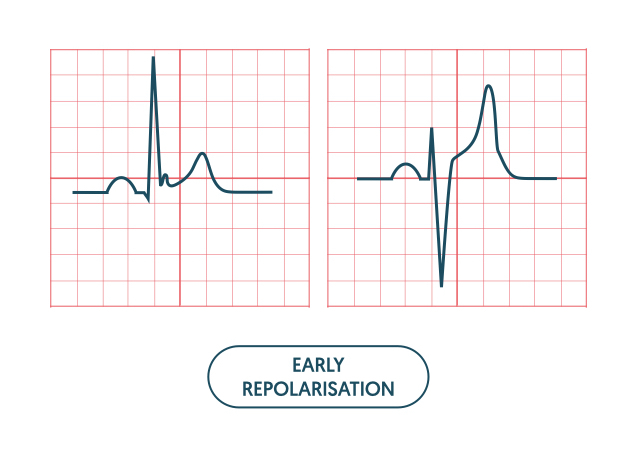 Pulsenotes  ST segment and T waves