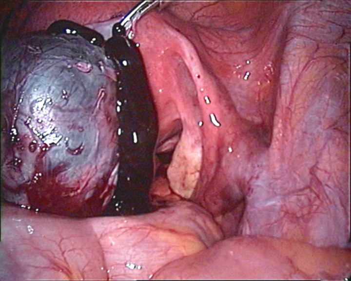 Endometrioma, seen on laparoscopy