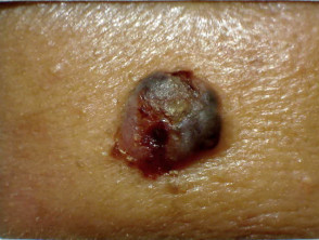 Nodular BCC