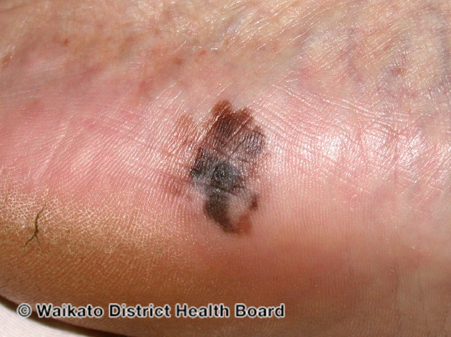 Acral melanoma in the sole of a foot in a darker skinned person