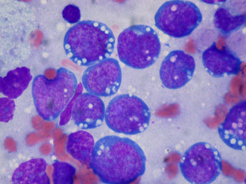 Burkitts lymphoma, touch prep, Wright stain