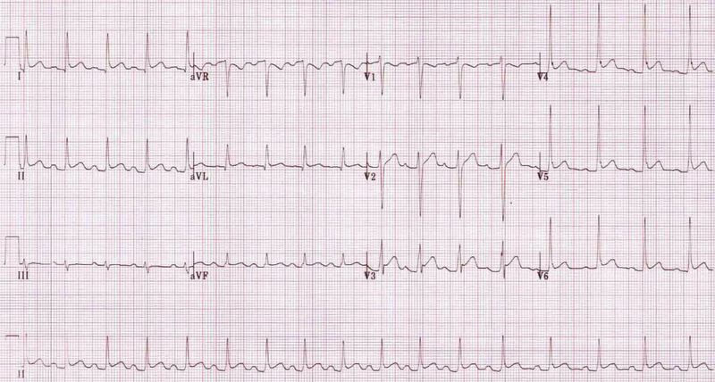 Pulsenotes  ST segment and T waves