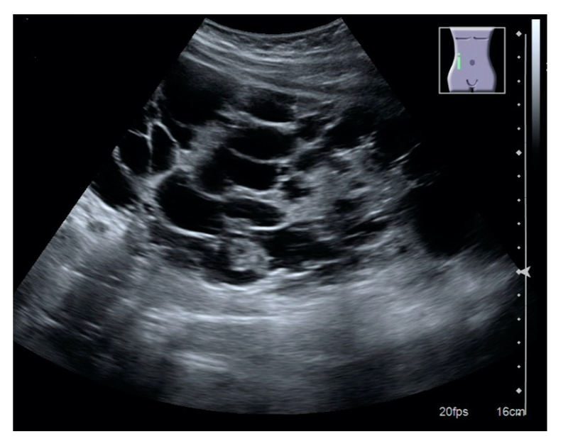 adult polycystic kidney disease ultrasound