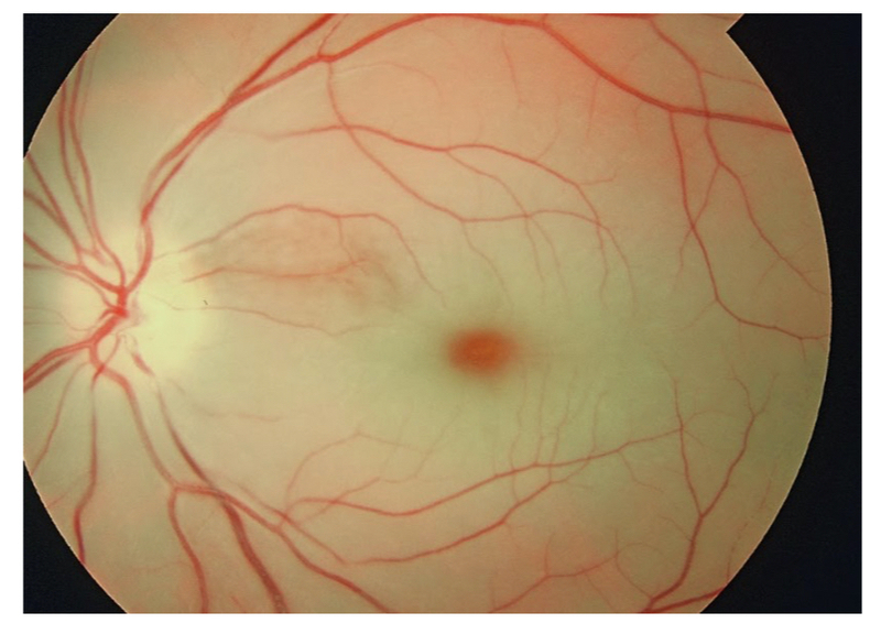 central retinal artery occlusion vs normal