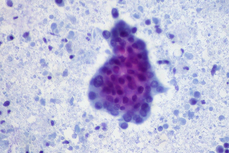 FNA showing pancreatic adenocarcinoma