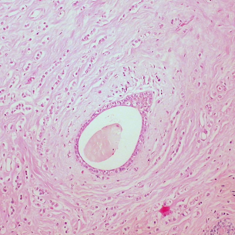 Invasive lobular carcinoma of the breast.
