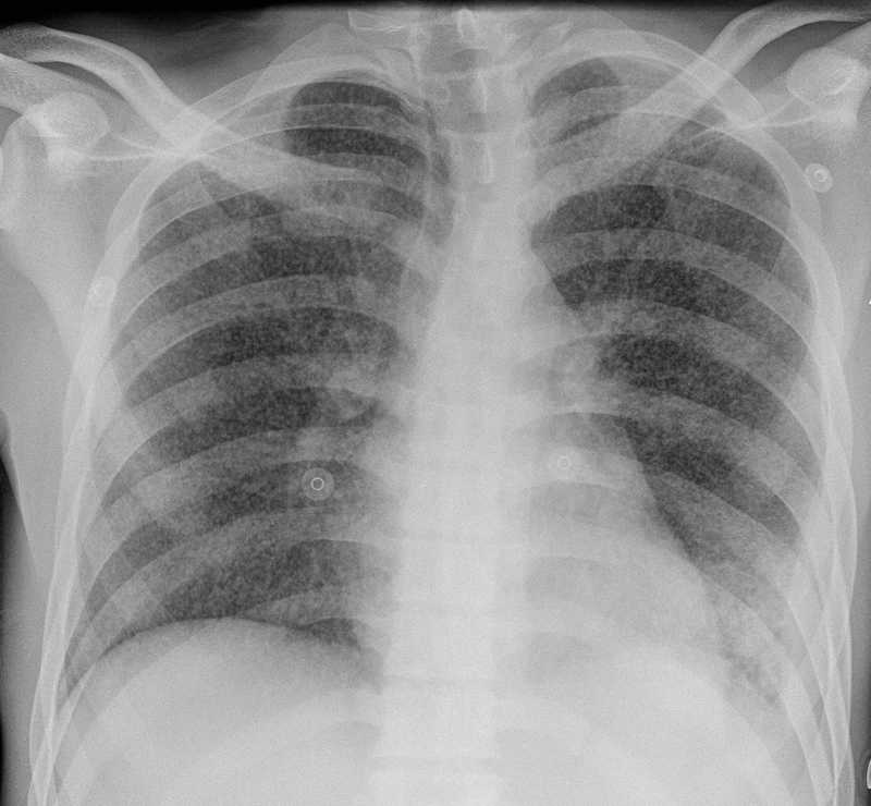 Miliary TB on CXR