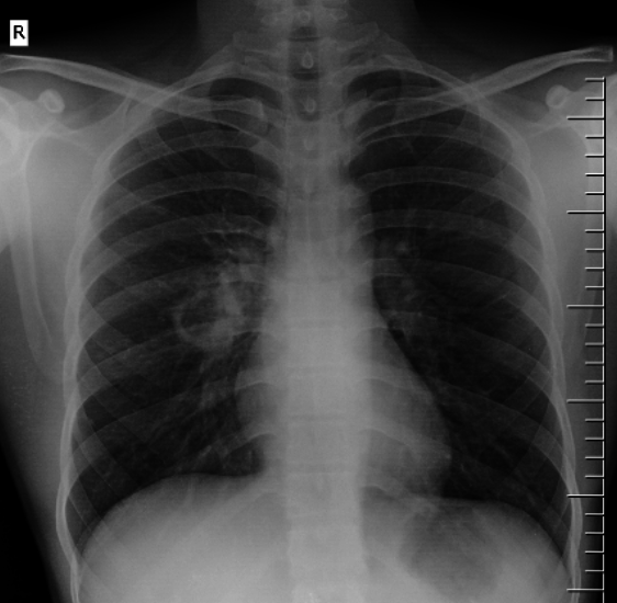 Pulmonary TB on CXR