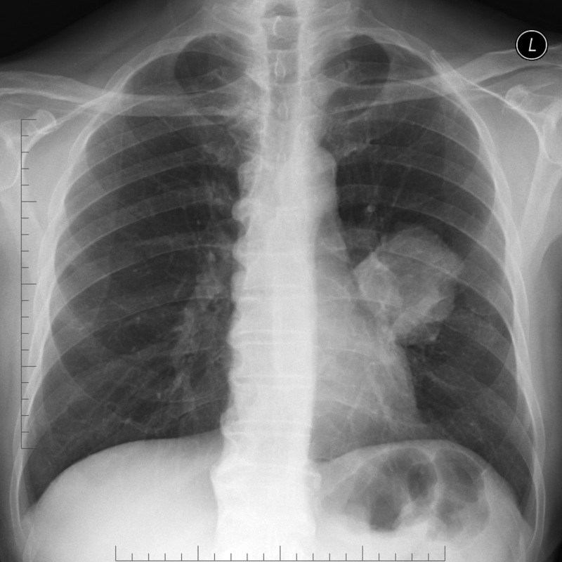 Lung cancer on CXR