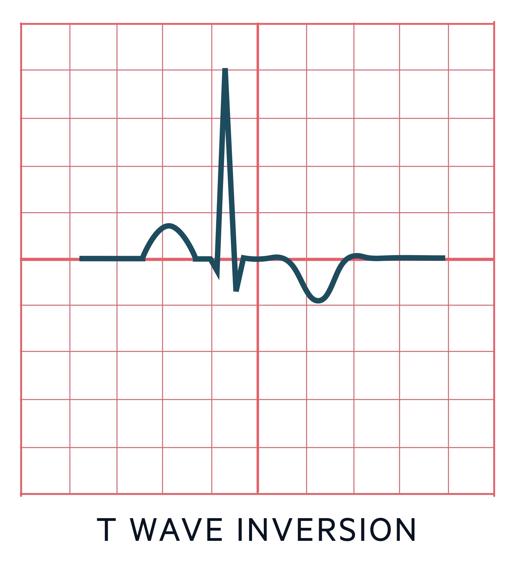 T wave inversion