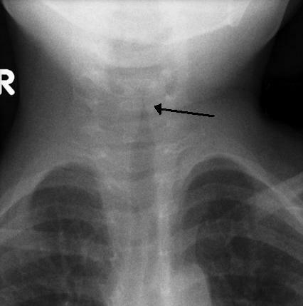 Steeple sign on x-ray (croup)