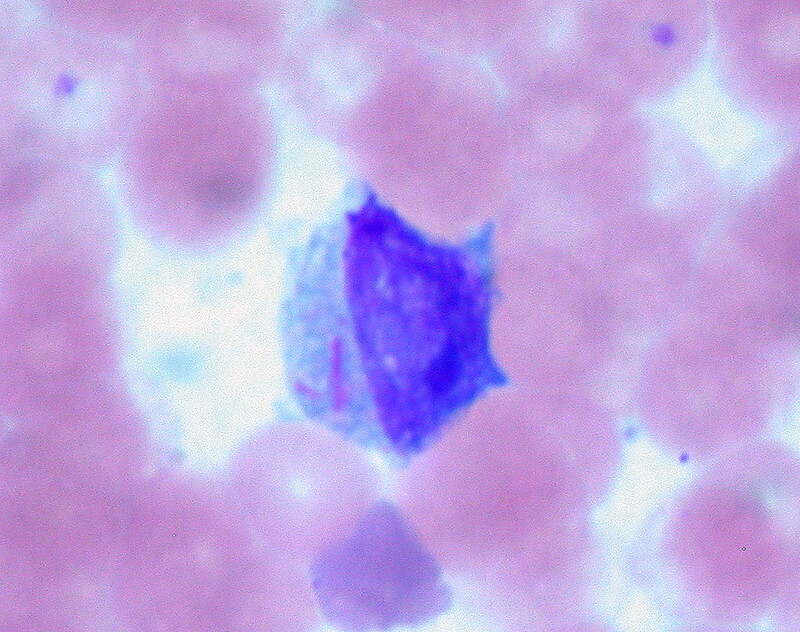 Auer Rods in a patient with AML