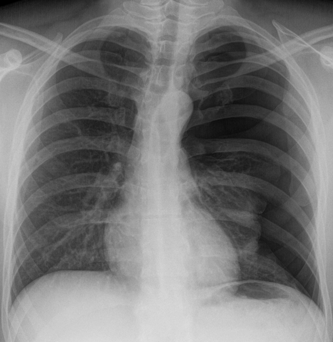Left sided pneumothorax 
