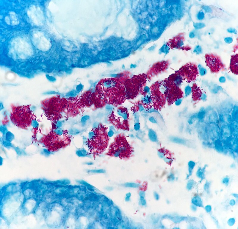 Colonic biopsy showing AFB