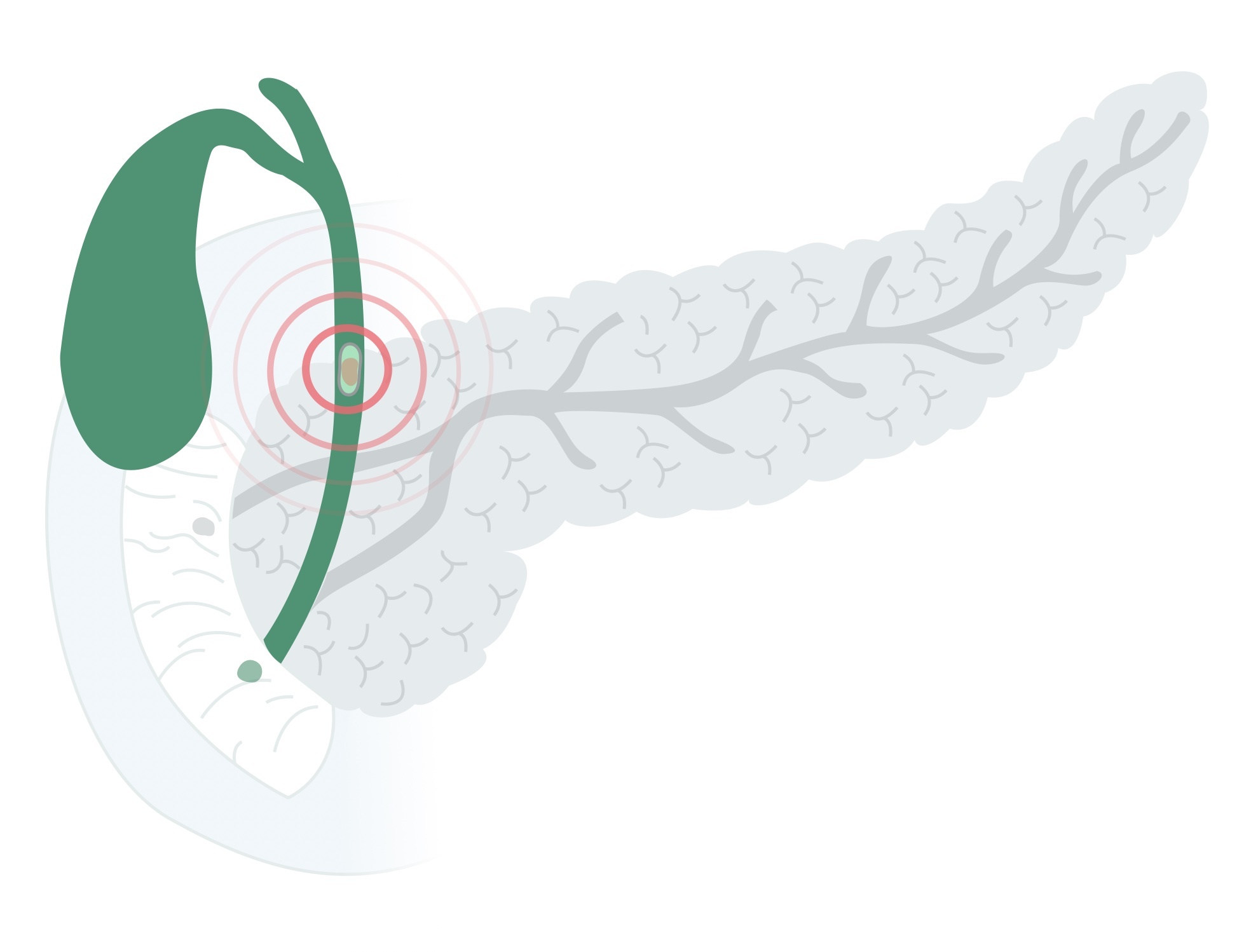 Gallstone in the common bile duct