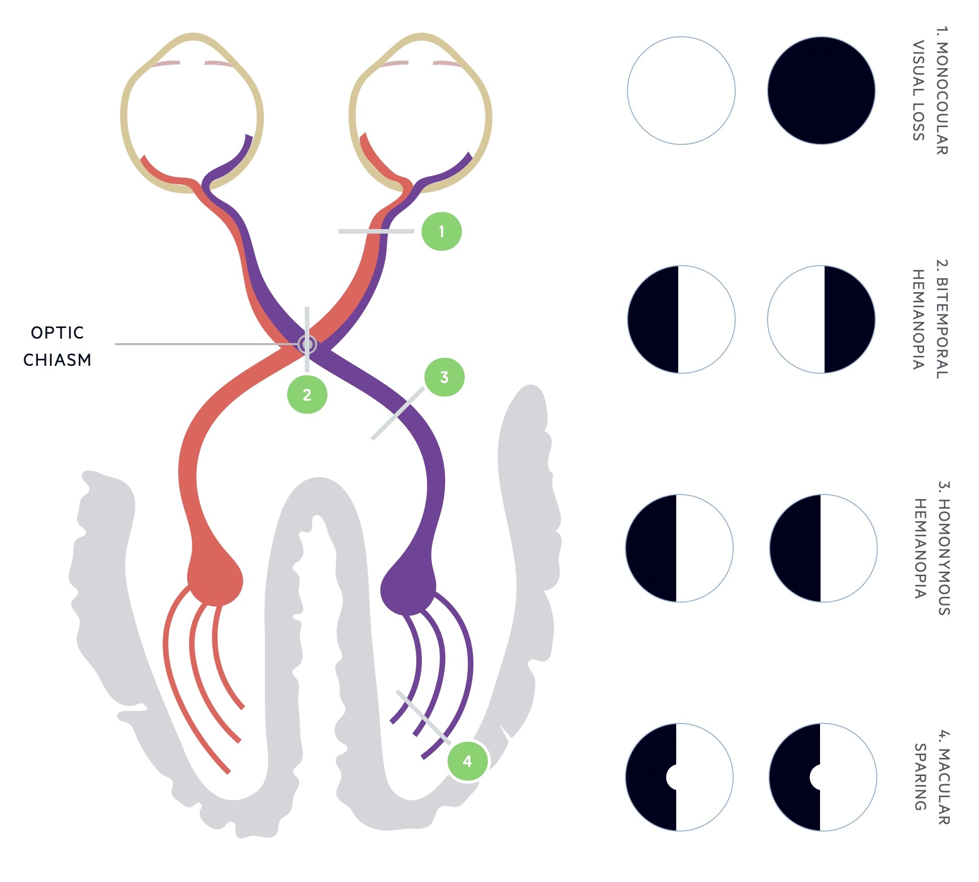 Visual defect depending on level of the lesion - bitemporal hemianopia