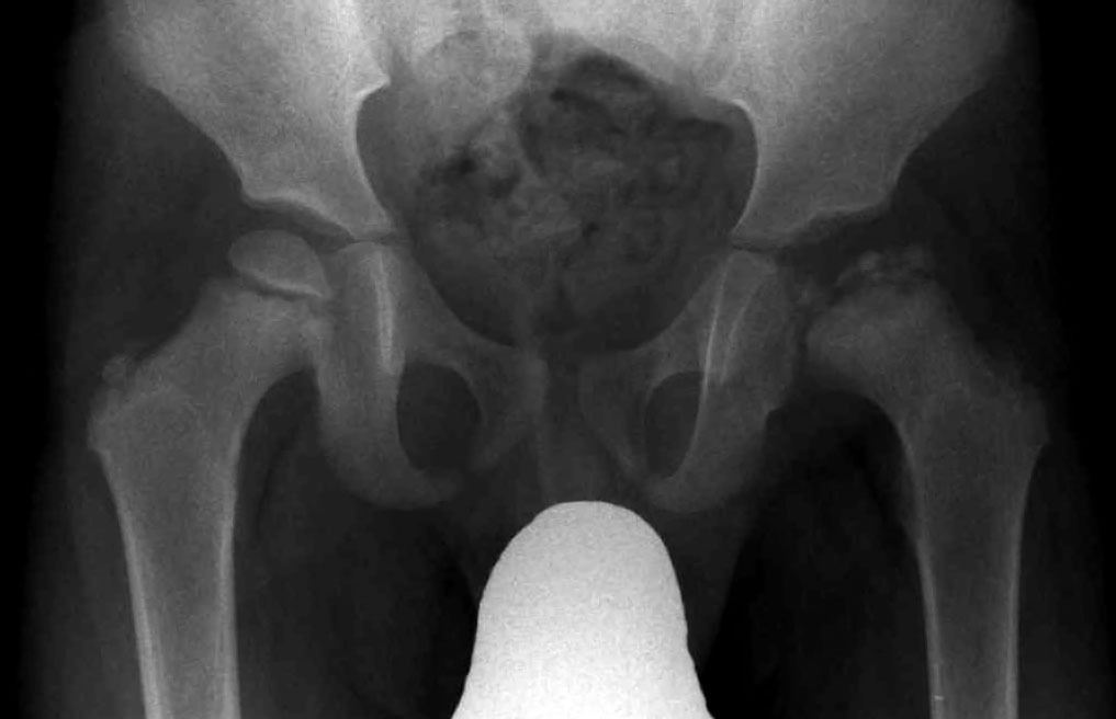 X-ray Perthes' disease