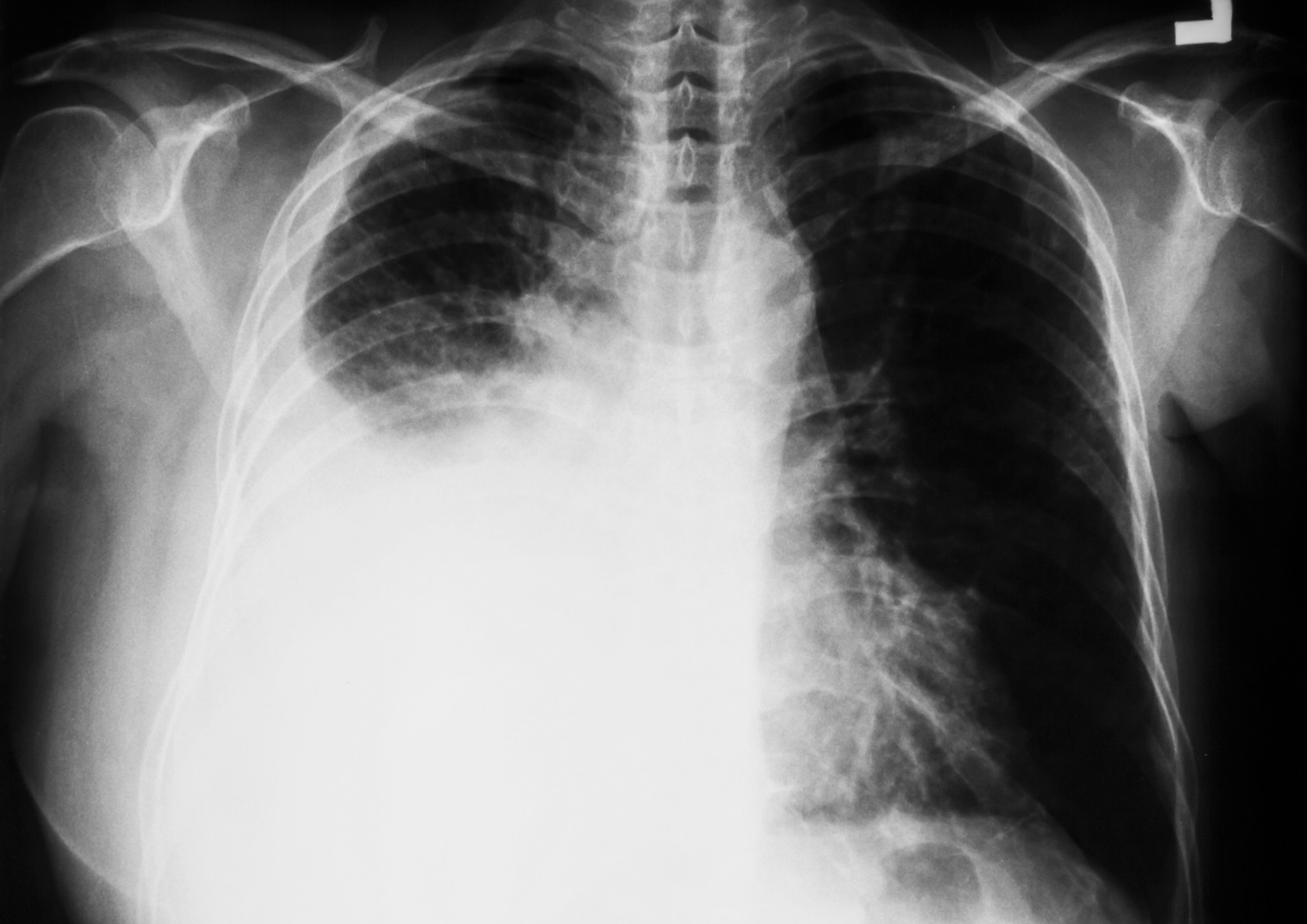 chest x ray pleural effusion