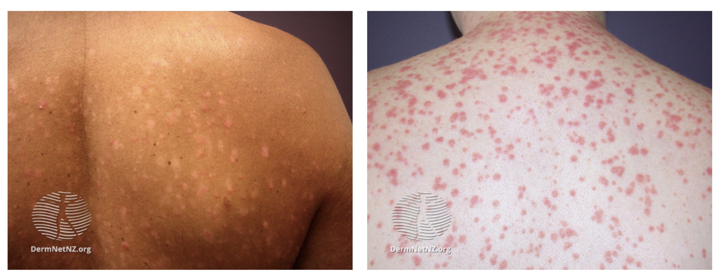 Guttate psoriasis