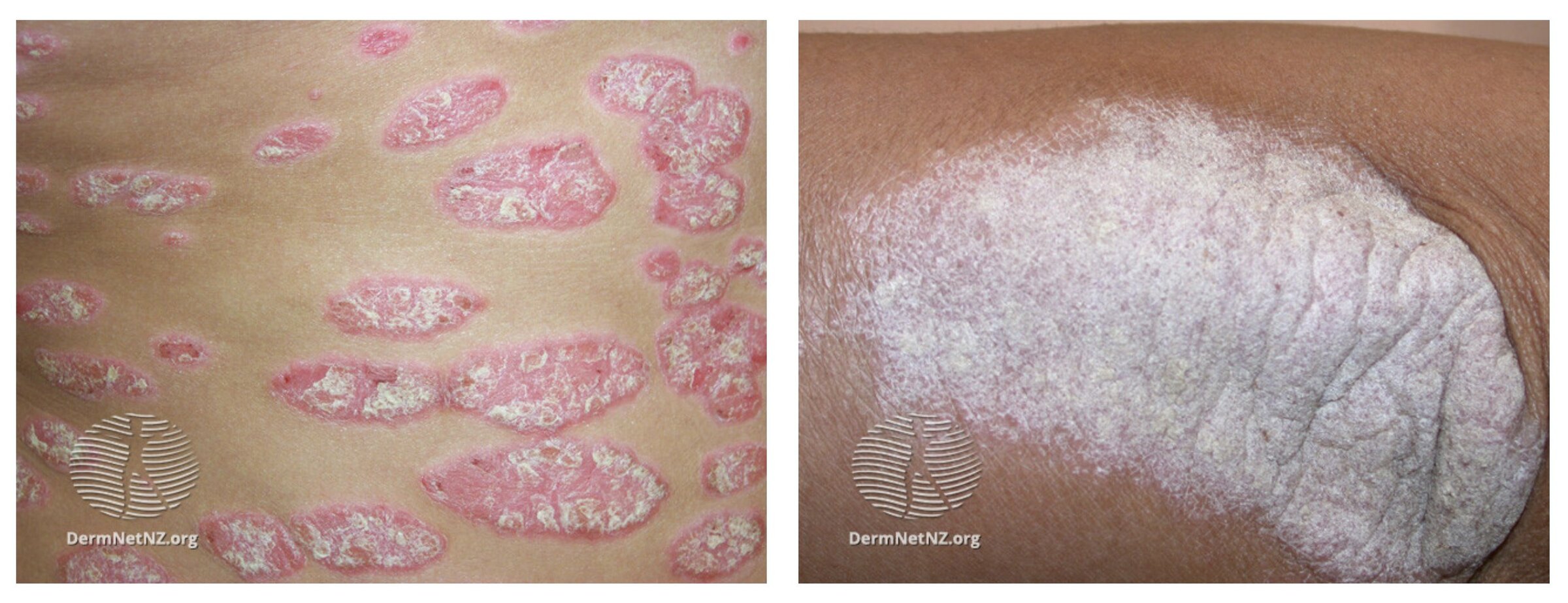 Chronic plaque psoriasis