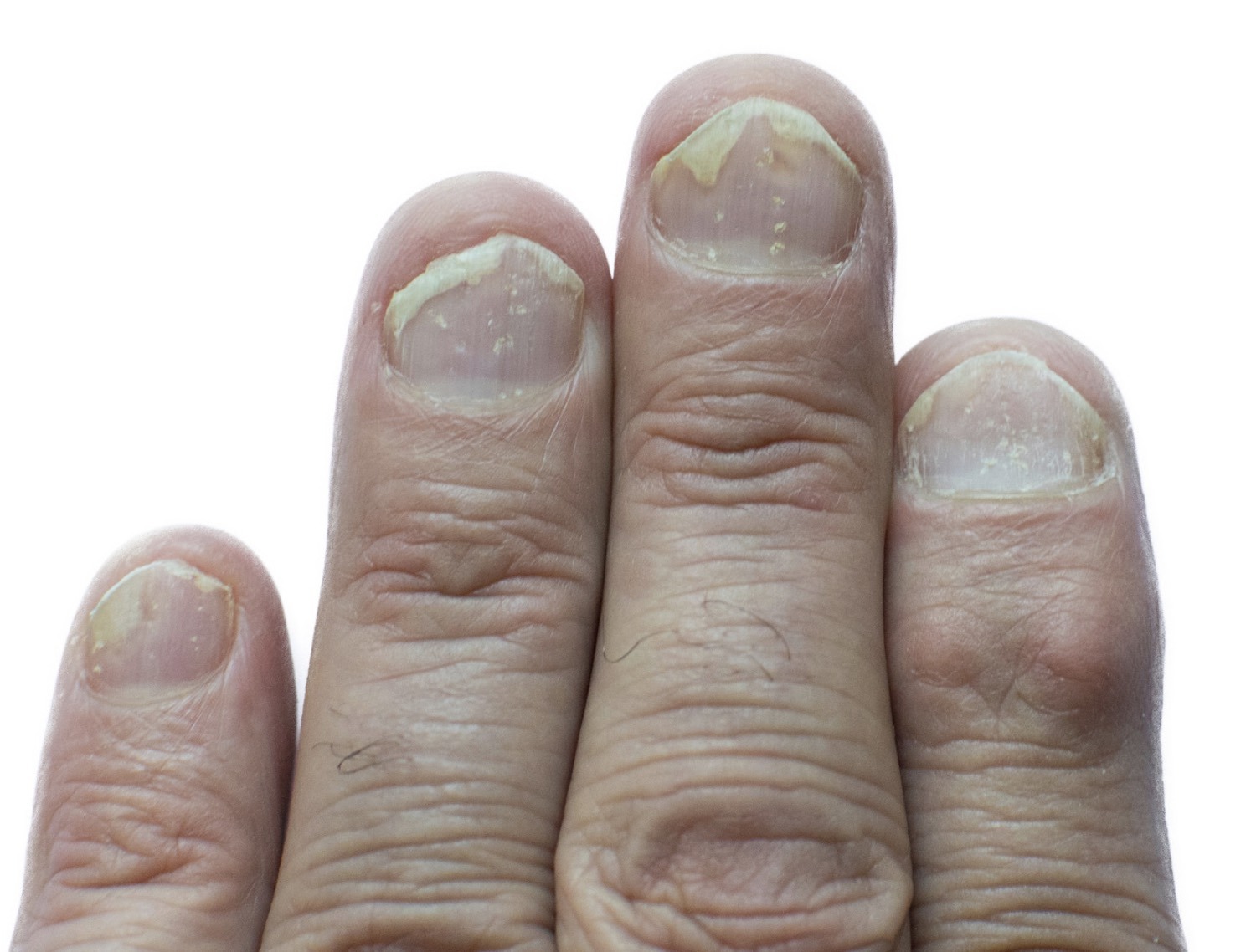 Nail psoriasis