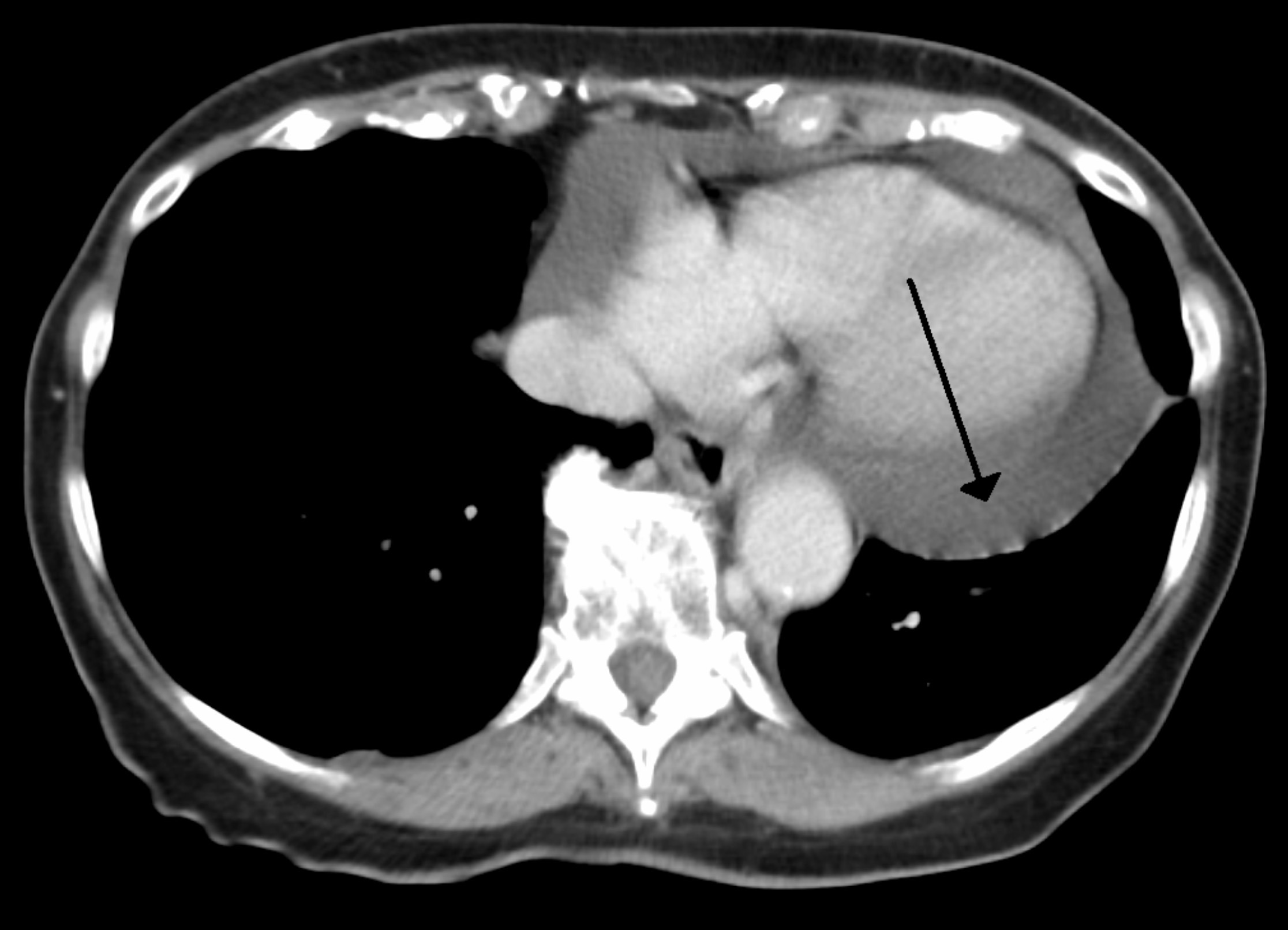 Pericardial effusion on CT