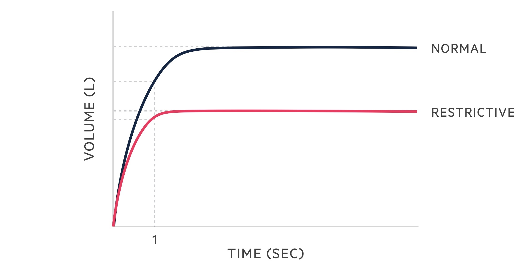 Restrictive lung disease spirometry