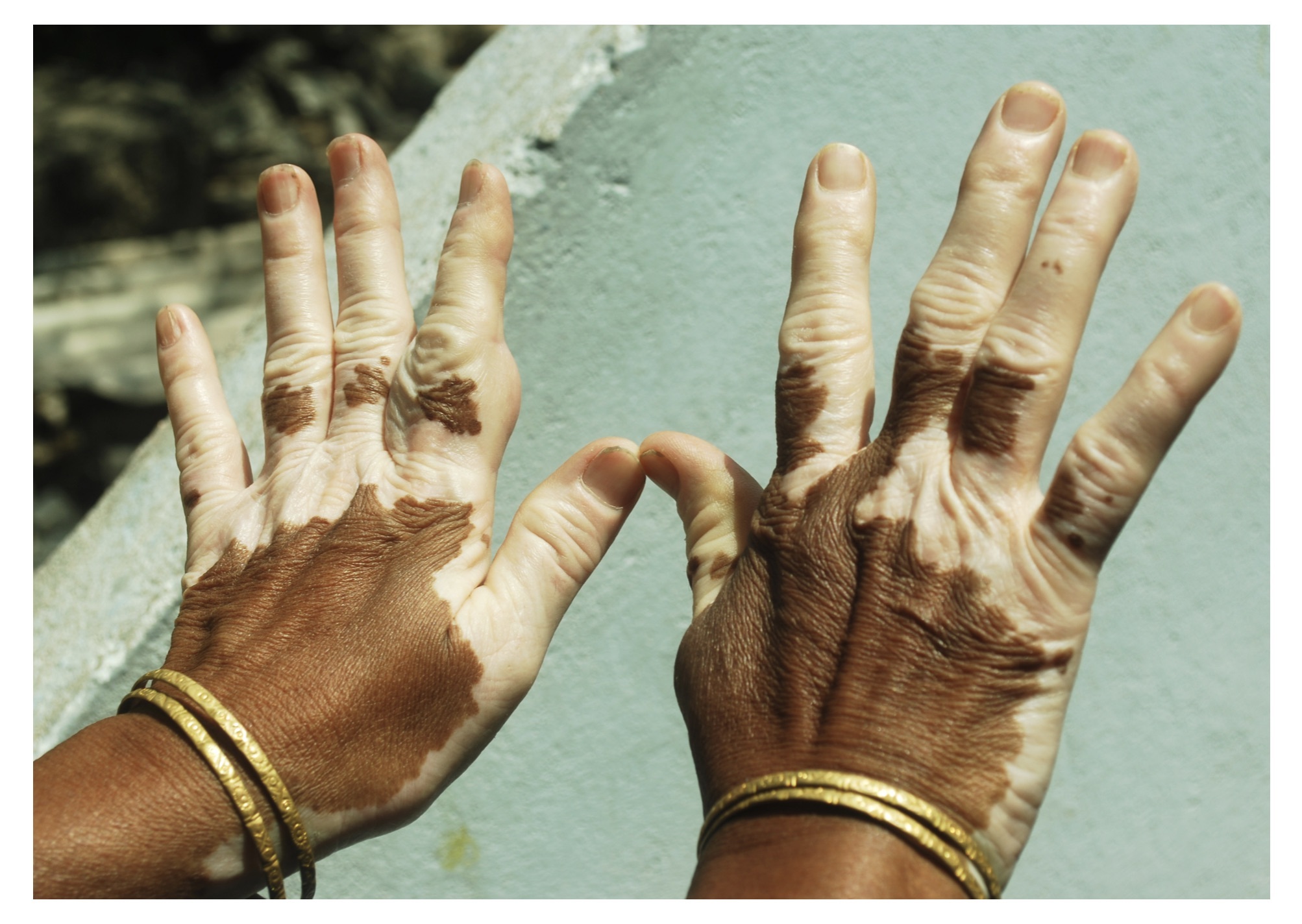 Vitiligo hands