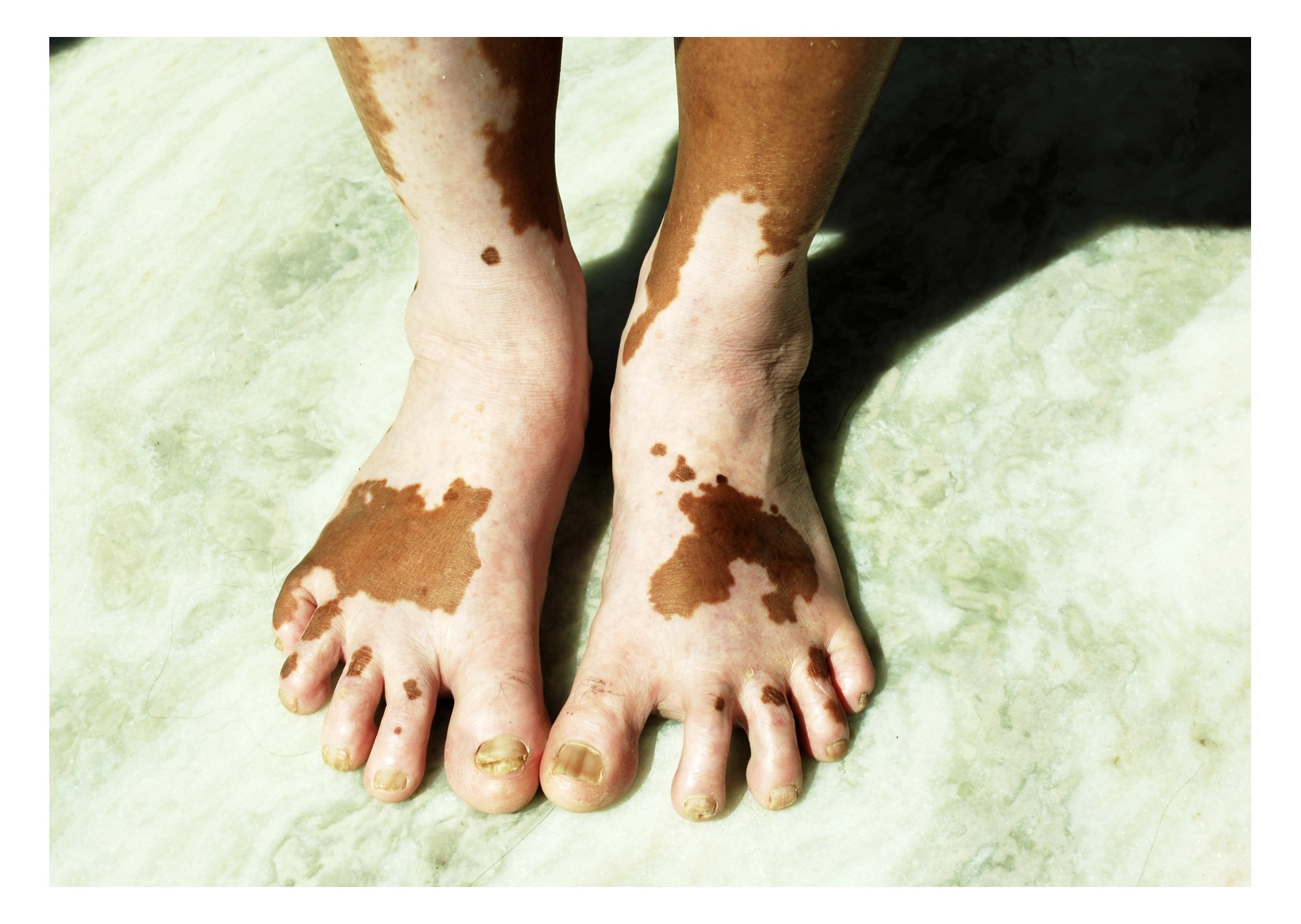Vitiligo feet