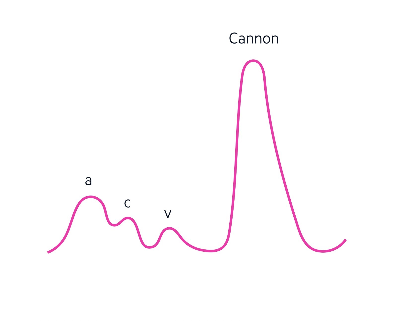 JVP - Cannon wave