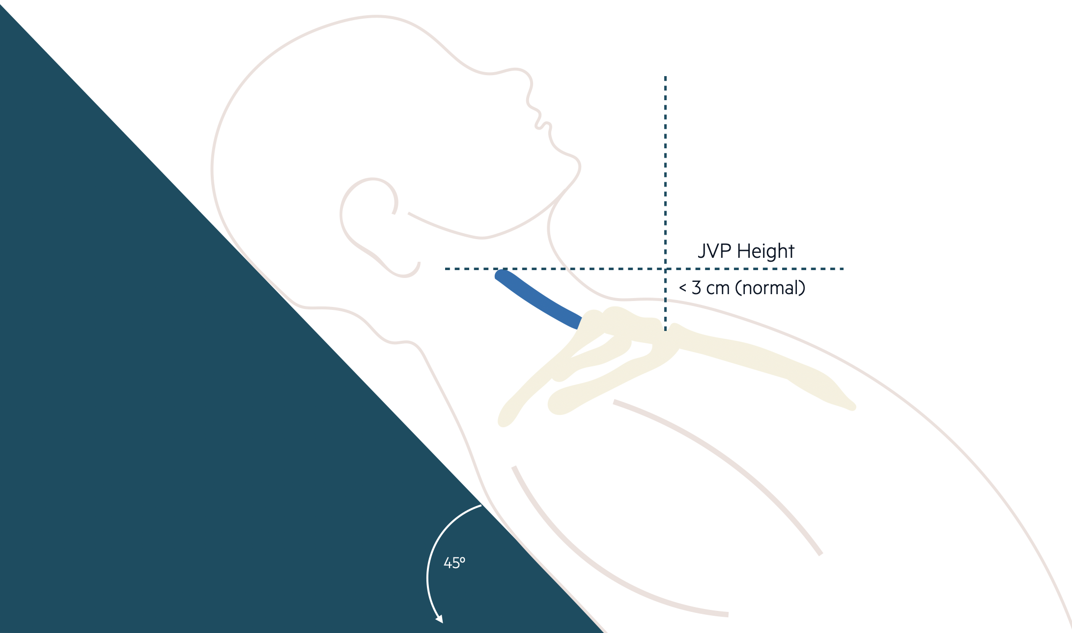 JVP measurement