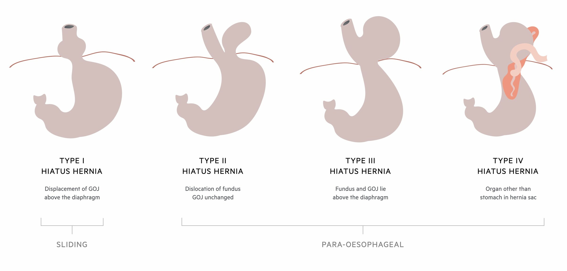 Hiatus hernia