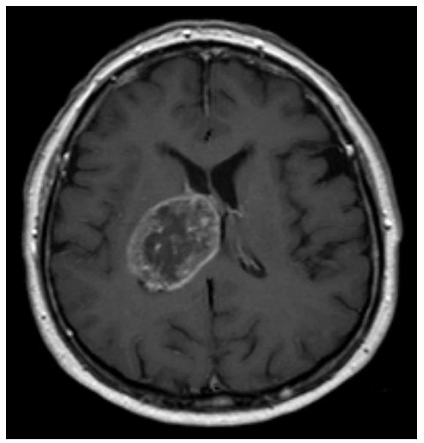 Glioblastoma MRI