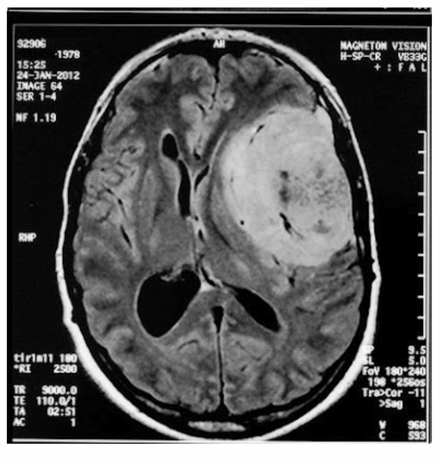Meningioma MRI
