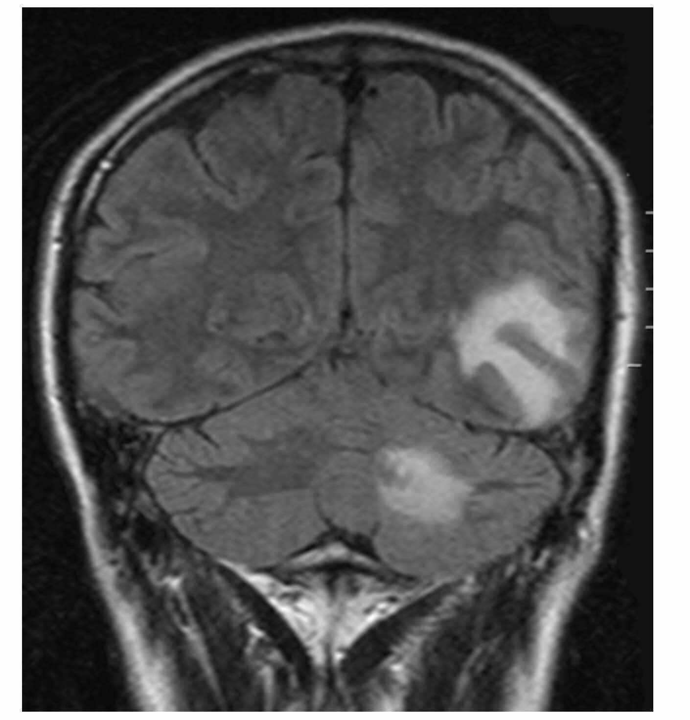 Brain metastasis MRI