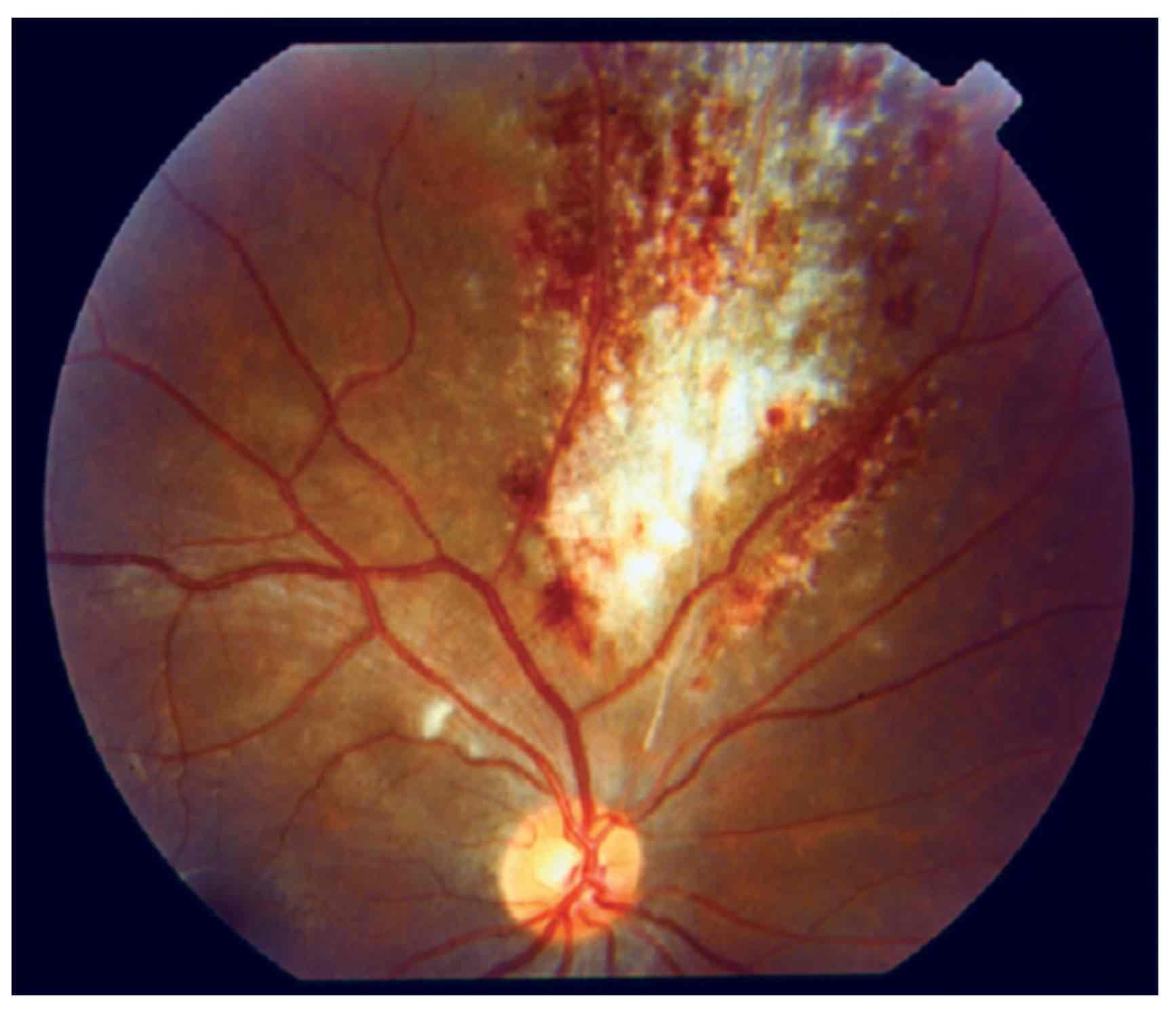 CMV retinitis (posterior uveitis)