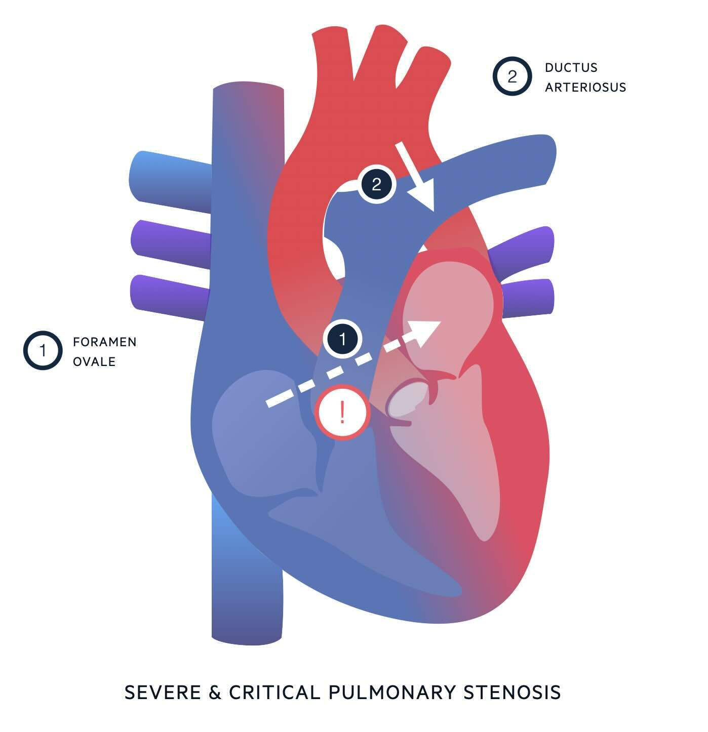 Severe and critical pulmonary stenosis