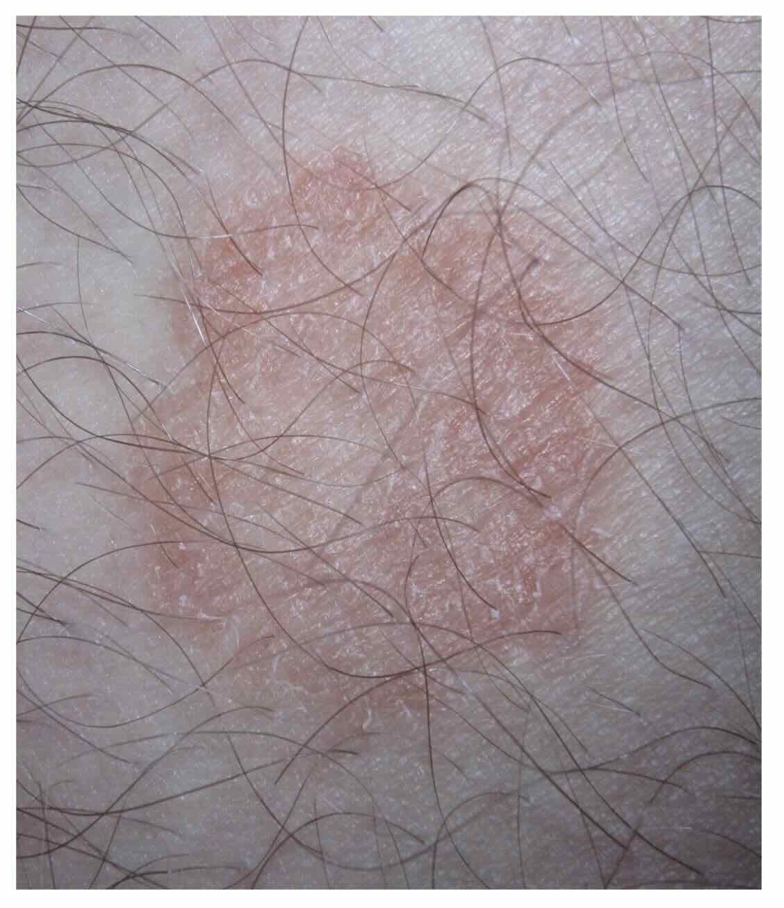 Dermatophyte fungal skin infection